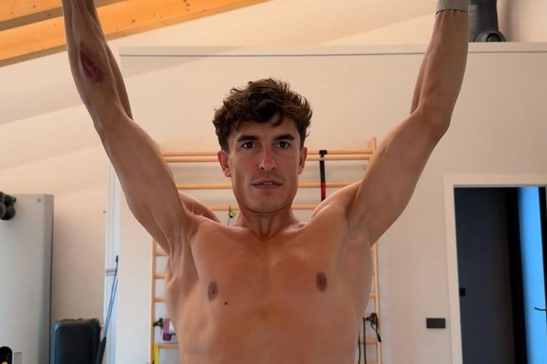 MotoGP | Marc Marquez mostra un'immagine shock del suo braccio destro